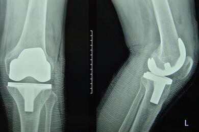 Так выглядит протез коленного сустава на рентгене. Фото: volynka.ru.