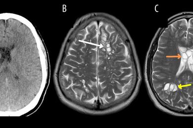 Снимки мозга больного с пораженными участками. Фото: American Journal of Case Reports